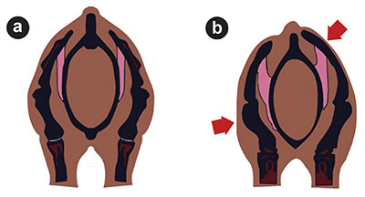 (a) Shows an even skeletal structure; (b) shows a distinctly higher left shoulder blade with a stronger humerus on the right.